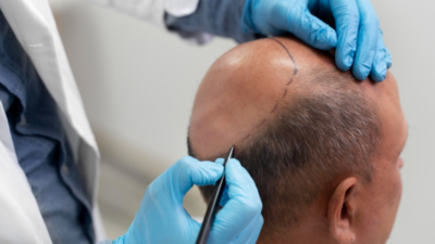 2 dead after hair transplant in Kanpur: 5 shocking truths about the risks